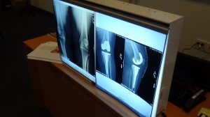 SMFT knee replacement March 2015 (2)